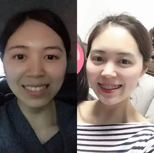 牙套前后对比