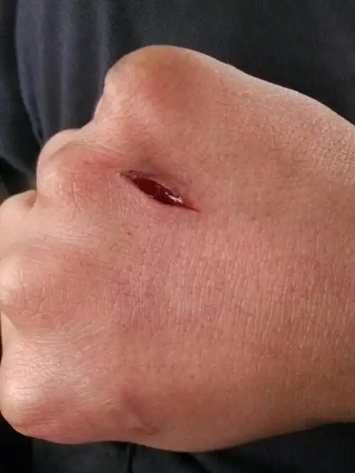 这样的伤口需要缝合吗?没怎么流血!