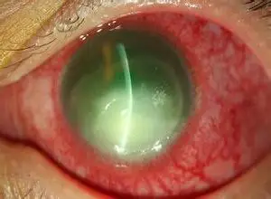 棘阿米巴性角膜炎,棘阿米巴性角膜炎如何治疗,棘阿米巴性角膜炎症状