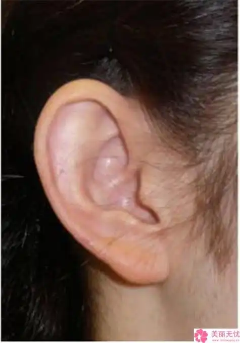 中国贴面耳反骨耳医院推荐:贴面耳反骨耳医院50强如何选