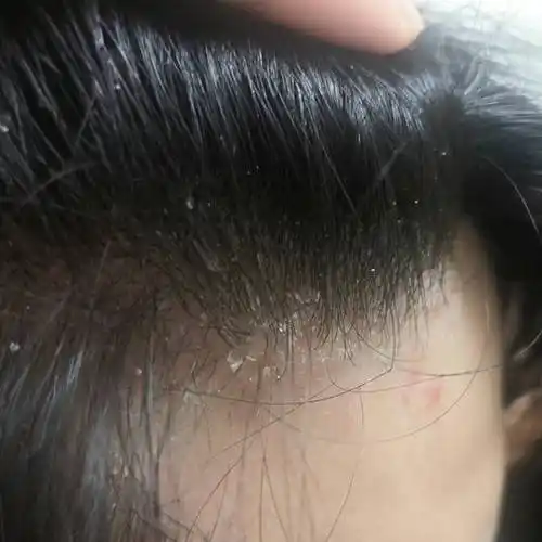 大块头屑,头痒,毛囊炎,小红疹和脂溢性皮炎都与头皮健康问题相关.