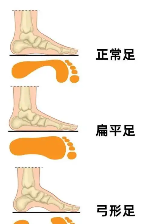 脚型分类与适合的鞋型