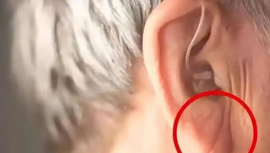 耳朵不同命不同?"穷人耳""富人耳"有啥差别?