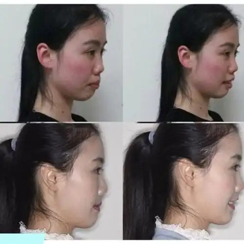 拔牙正畸脸型塌陷照片拔牙矫正嘴巴瘪了图片矫正牙齿内收过多嘴瘪拔牙