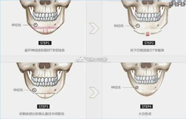 下颌角基础术式科普长曲线下颌角和颏部缩小形成术有什么区别