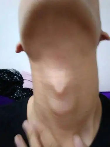 脖子松弛,喉结上面里面长了个半圆小硬块