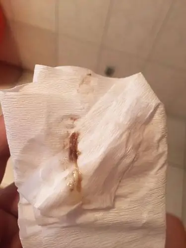 下面有流褐色的像白带一样的东西!是要生孩子的节奏吗?