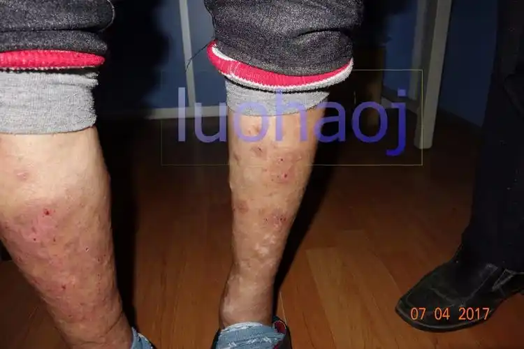 下肢顽固性湿疹伴溃疡案例 - 好大夫在线