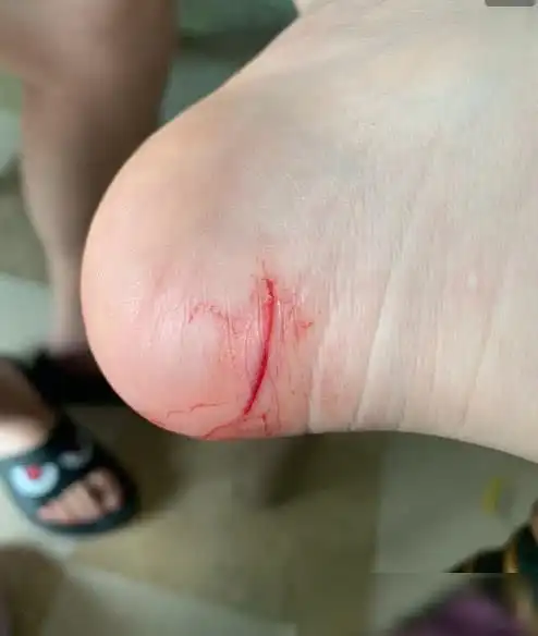 赵梦玥为做饭砍到脚,看了卢本伟的做法,网友:不分手留着过年?