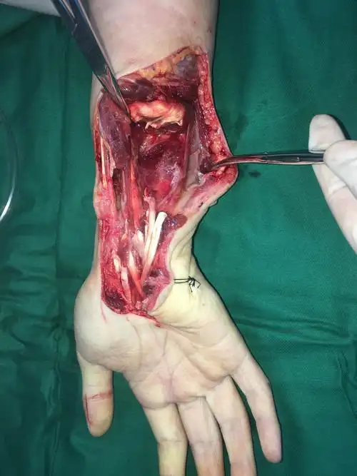 骨伤科 前臂切割伤手术1例