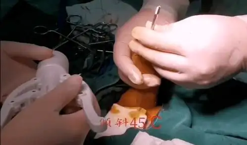 手术演示丨吻合器包皮环切术