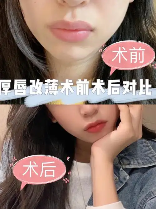 厚唇改薄m唇.刚画完线的蛡5,图1术前术后对比