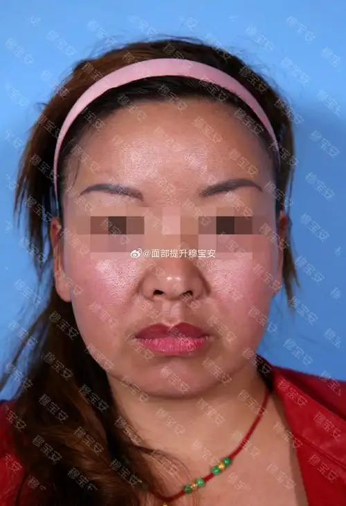 苹果肌下移,下颌缘模糊,皮肤毛孔也比较粗大