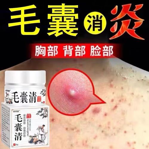 昕雨堂头皮溢脂性毛囊炎专用膏痤l疮脖子胸口后背长痘痘真菌感染瘙痒