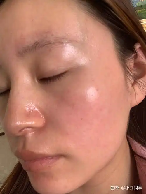 如何修复肌肤屏障肌肤屏障受损怎么修复