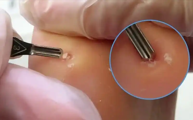 实拍拔鸡眼全过程挖完真的好舒适啊油兔不二字幕组