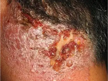 秃发性毛囊炎的症状和图片 - 有来医生