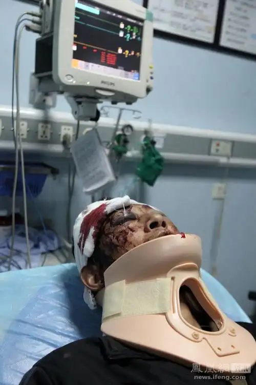 图为一名头部严重受伤的男子躺在医院的重症病房里,昏迷中.
