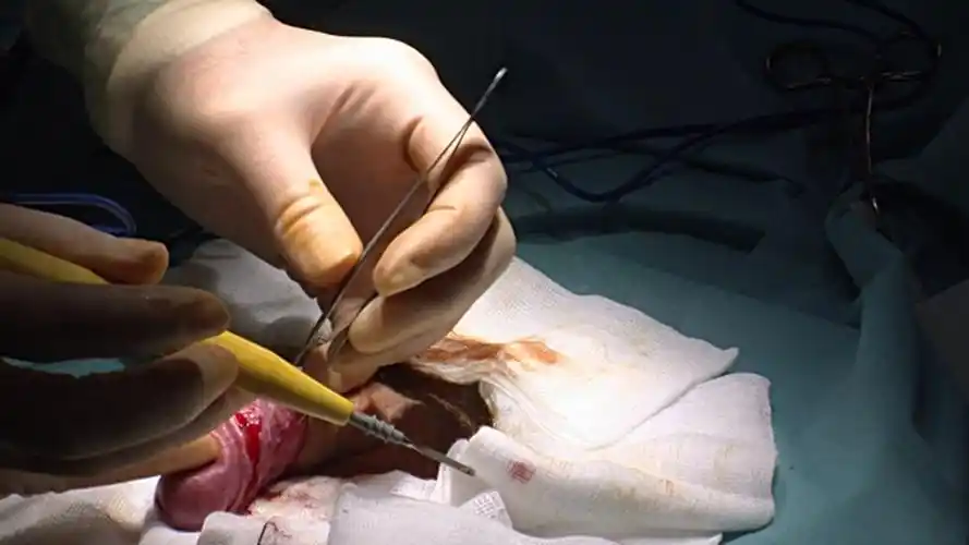 包皮过长做手术图片