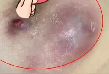 乳房红肿胀痛皮肤破溃仅半月恶化成不死的癌症乳腺科专家辛明提醒你不