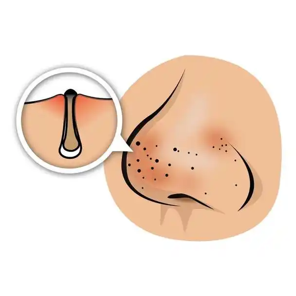 「健康英语」"黑头"用英语咋说?以及黑头能挤么?