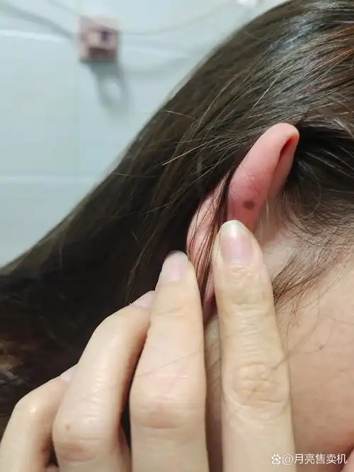 30年 ,没发现耳朵后面原来有颗痣