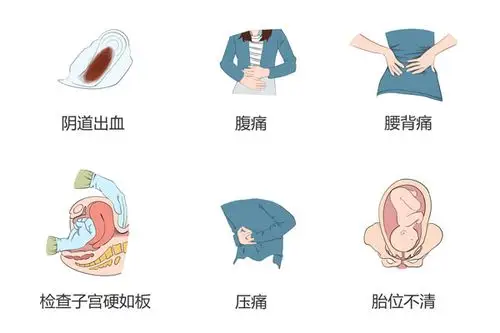 如何判断胎盘早剥