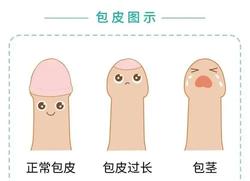 男人们割完包皮后都说很爽是真的吗