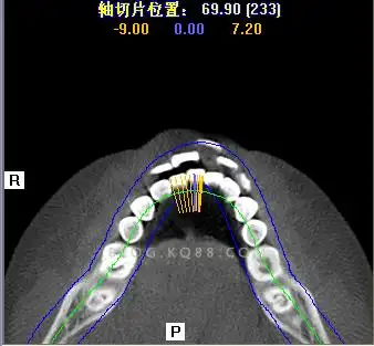上颌第一双尖牙3牙根--屈晓兵