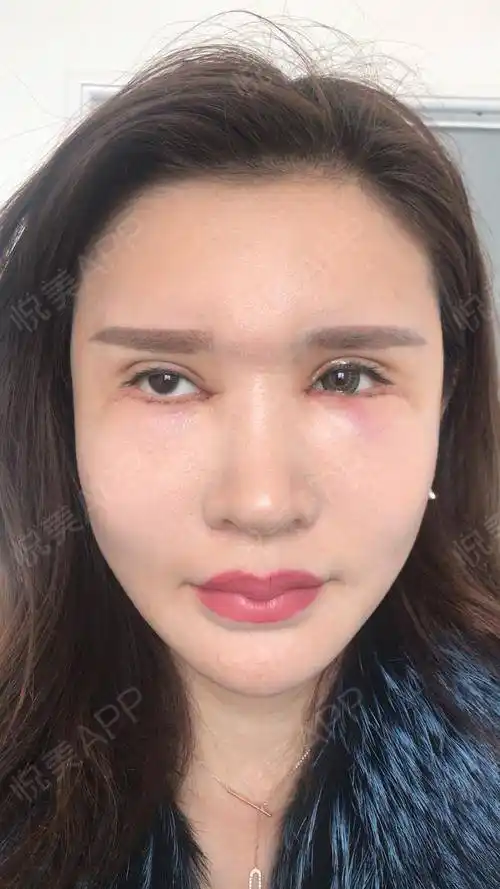 记录下我的内眼角2次修复 眼睑下至 历程 给姐妹们做个参考