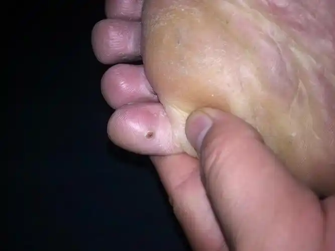 化脓性肉芽肿一例.谈谈治疗,后续报道.