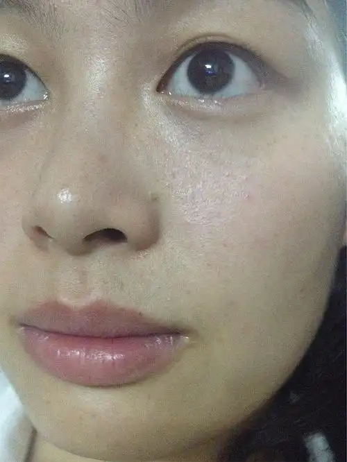 脸颊毛孔粗大怎么解?话不多说,上图