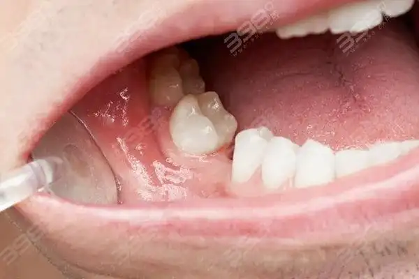 一个老牙医的10条种植牙忠告不要随意做种植牙