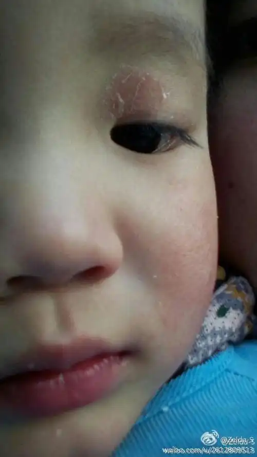 2岁2个月眼皮上长的这个是什么呀,谢谢