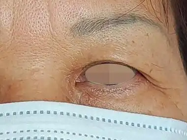 眼睑皮肤松弛症的症状和图片 - 有来医生