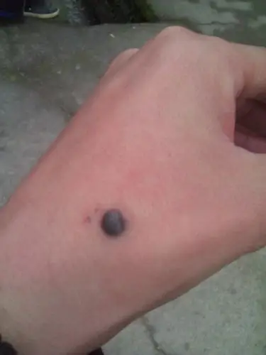 手背上长着一颗黑痣,有必要挖掉吗?
