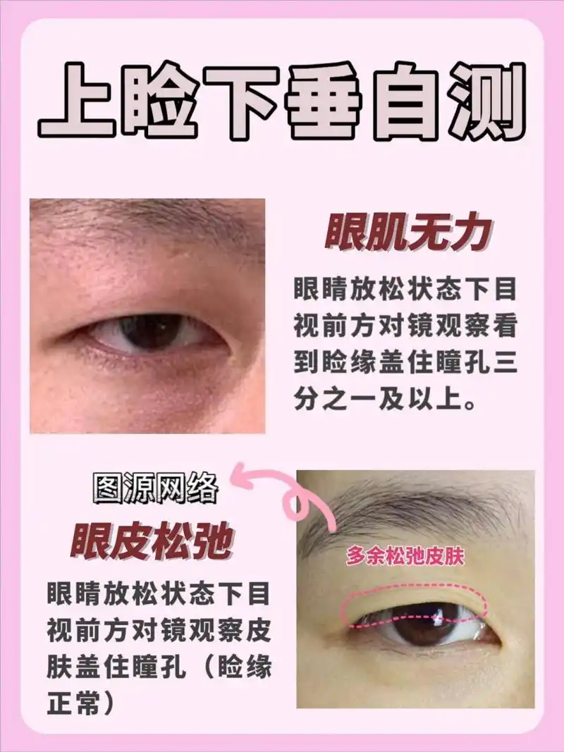 上睑下垂自测 30秒分辨眼肌无力和眼皮松弛 眼肌无力和眼皮松弛在临床