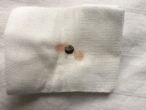 5毫米金属误进眼内,医生巧手取出保住眼球