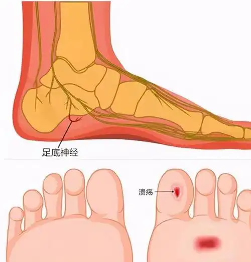 中老年人出现脚底板疼,常有5种病因,医生告诉您如何鉴别及治疗|骨刺