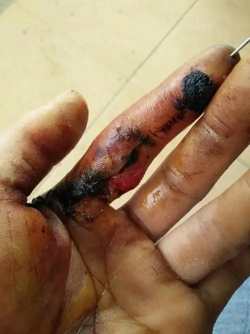 手指受伤了,已经一个月了,局部黑黑的(可能坏死),其余肉也硬硬的,没啥