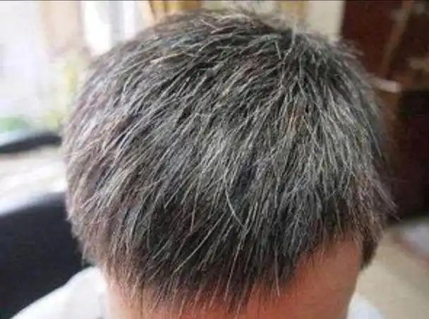 长了白发可以拔掉吗?建议了解