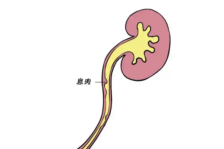 输尿管息肉图片