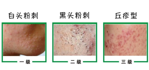 (19年6月更新版)终结痘痘粉刺和黑头,掌握这8个抗痘原则(外加教手痒的