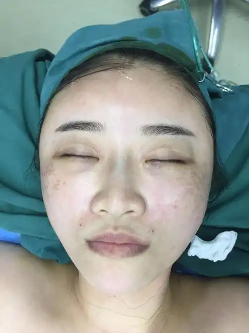 术后即刻刚做完的脂肪填充,自己都看不习惯了,但是陪_圈子-新氧美容