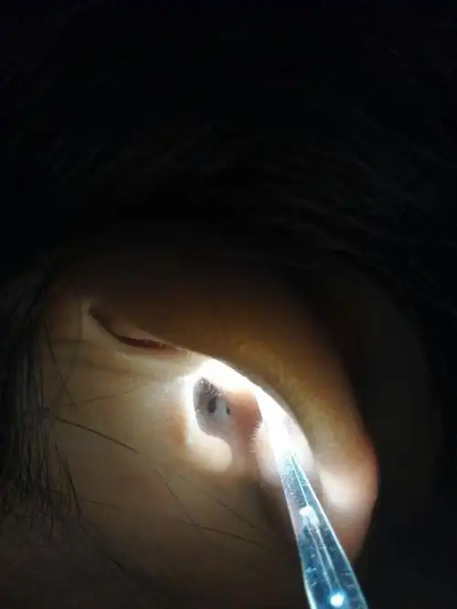 朋友外耳道口长了个绿豆大小的黑色颗粒,在皮下,两头已经透出口,就像