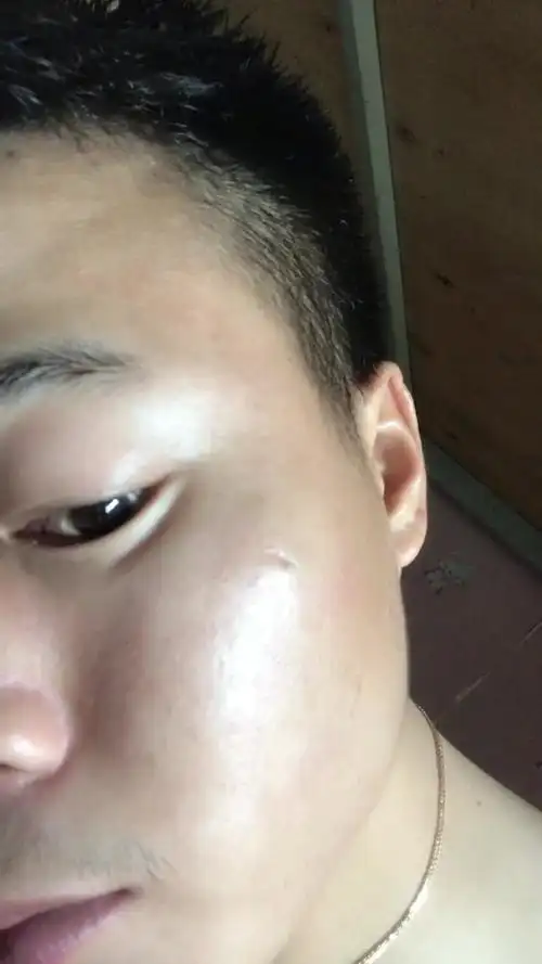 脸上长了个肉瘤做了手术3个月了脸皮肤还没愈合,还有一个小窝怎么回事