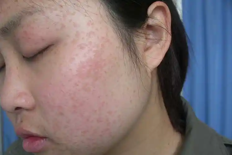 扁平疣的症状_扁平疣_苏州乐桥皮肤专科,苏州医保定点皮肤病专科,苏州