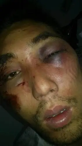 被打舅青脸肿图片真人版