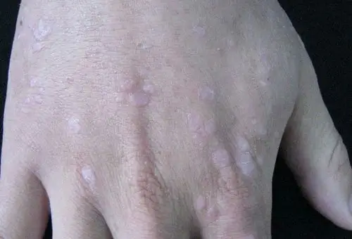 手背扁平疣图片