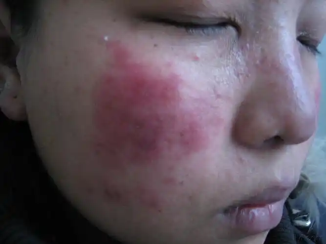 播散性盘状红斑狼疮(ddle)1例 - 皮肤及性传播疾病讨论版 - 爱爱医